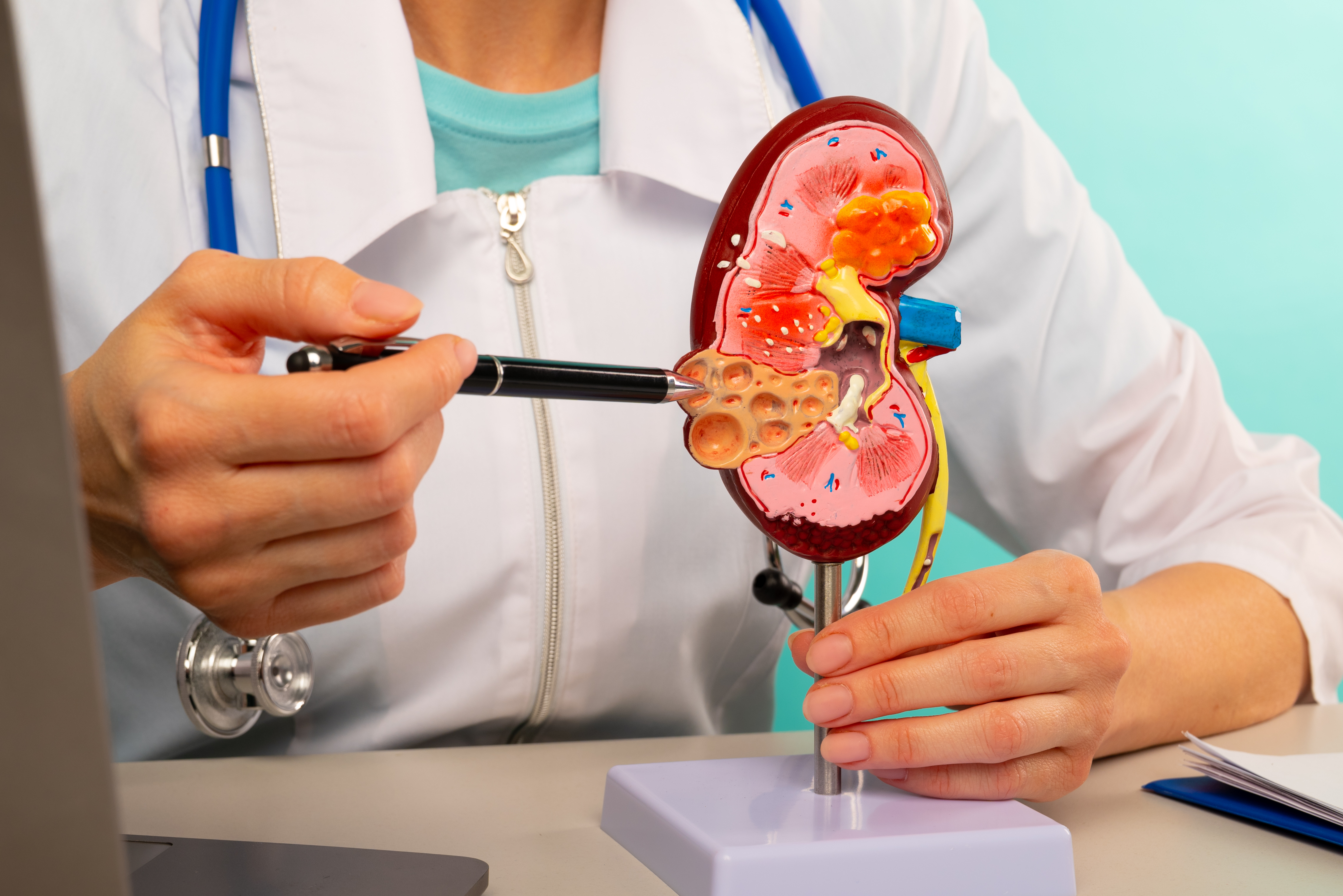 Otozomal dominant polikistik böbrek hastalığı ömür boyu sürüyor